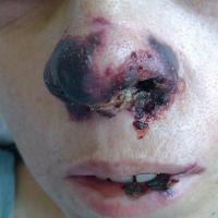 
	Wegener&rsquo;s granulomatosis