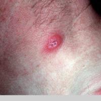 
	Wegener&rsquo;s granulomatosis