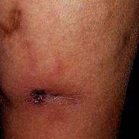 
	Nodular vasculitis&nbsp;

	Copied with kind…