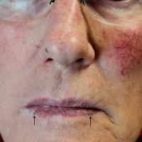
	Venous lake on the lips

	Two lesions (black…