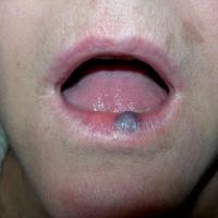 
	Venous lake on the lips