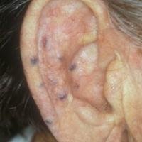 
	Venous lakes on the ear
	
	Multiple…