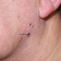 
	Same patient as figure 5
	
	The lesion…