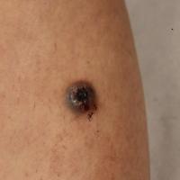 
	Venous tumour - benign 
	
	This lesion was…