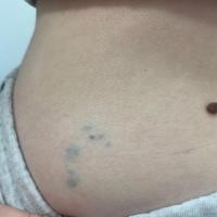 Glomulovenous malformation (GVM)
Copied with…