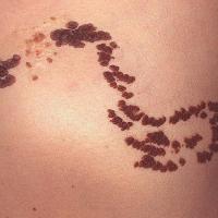 
	Verrucous epidermal naevus on the trunk -…