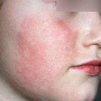 
	Erythema infectiosum