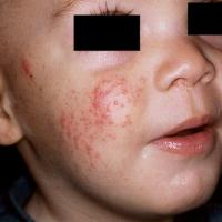 
	Gianotti-Crosti syndrome

	The face, buttocks…