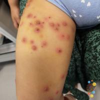 Chickenpox&nbsp;
Copied with kind permission…