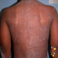 Chickenpox 
Copied with kind permission from…