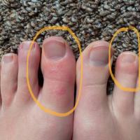 Covid toes