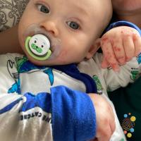 Eczema coxsackium
Copied with kind permission…