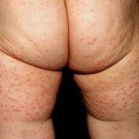 
	Gianotti-Crosti syndrome

	Monomorphic…