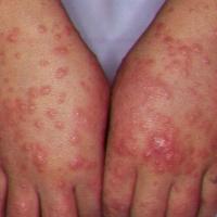Gianotti-Crosti syndrome
Copied with kind…