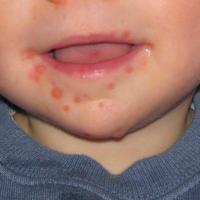 
	Hand, foot and mouth disease