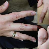 
	Hand, foot and mouth disease

	Copied with kind…