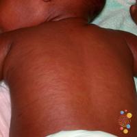 Measles&nbsp;
Copied with kind permission…