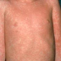 
	Measles
