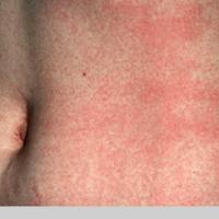 
	Measles