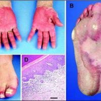 
	Papular-purpuric gloves and socks syndrome