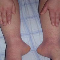 
	Papular-purpuric gloves and socks syndrome