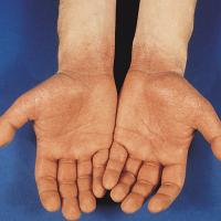 
	Papular-purpuric gloves and socks syndrome