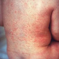 
	Rubella

	Although the rash has a similar…