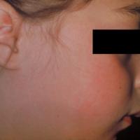
	Rubella

	Causing a malar rash