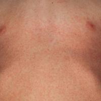 
	Scarlet fever

	A fine, papular, red rash that…