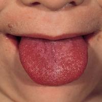 
	Scarlet fever - strawberry tongue