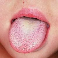 
	Scarlet fever - white tongue