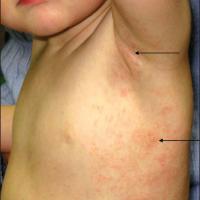 
	Unilateral laterothoracic exanthem