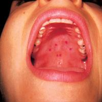 
	Hand, foot and mouth disease - oral lesions