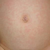
	Roseola
