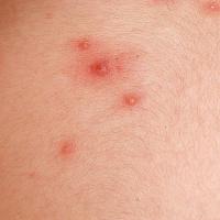 
	Chickenpox

	Crops of lesions at different…