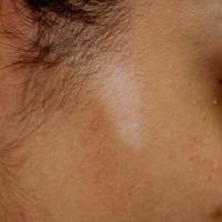 
	Vitiligo right cheek: pre-treatment 