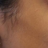 
	As previous image: four months into treatment,…