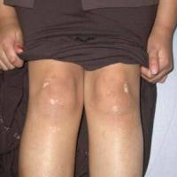 
	Same patient 
	
	After three months of…