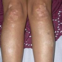 
	Same patient as previous image

	Six weeks…