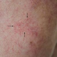 
	Telangiectasia secondary to super-potent…