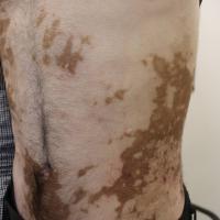 
	Vitiligo - extensive