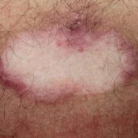 
	Inflammatory vitiligo&nbsp;