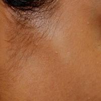 
	Same patient as previous image

	Two months…