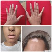Vitiligo
As with this case, patients with skin…