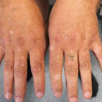 
	Vitiligo of the hands 