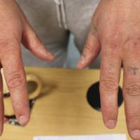 
	Same patient as previous image

	After three…