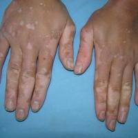 
	Vitiligo