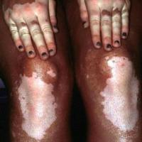 
	Vitiligo in black skin
	
	In skin of…