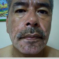 
	Vitiligo&nbsp;