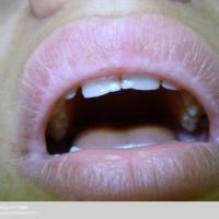 
	Vitiligo - lips